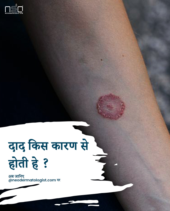 दाद के कारन ( daad ka karan )